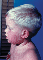 Child with measles rash, highlighting the symptoms of measles, relevant to public health discussions on vaccination effectiveness and outbreak prevention.